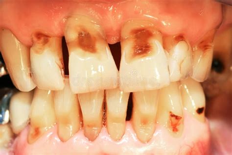 Teeth Abrasion Stock Photos - Image: 28636143