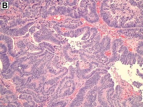 Streptococcus Gallolyticus Group Bacteremia And Colonic Adenocarcinoma