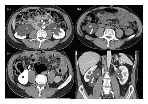 (a) The nephrogram phase of the contrast enhanced CT scan shows severe... | Download Scientific ...