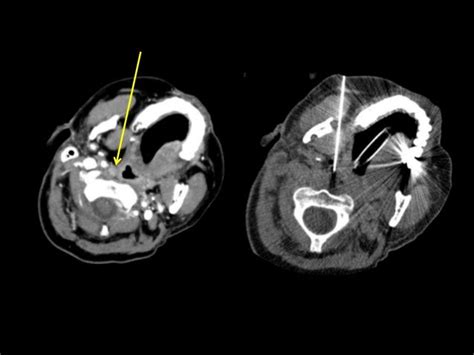 Image Guided Head And Neck Biopsy