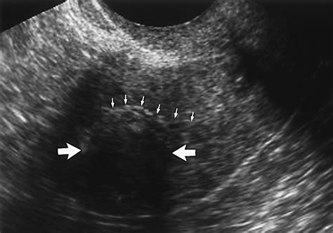 uterine adenomyosis endovaginal    imaging features