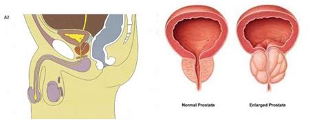 Transurethral Resection Of The Prostate Turp Procedure In Chennai