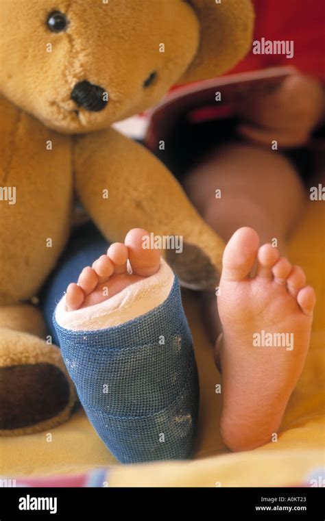 young child with broken leg in plaster cast Stock Photo - Alamy