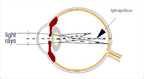 Astigmatism