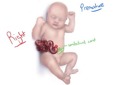 GI And GU Disorders Flashcards Quizlet