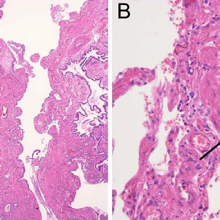 Figure4 Microscopic Findings Of The Lower Lobes Of The Lungs A The