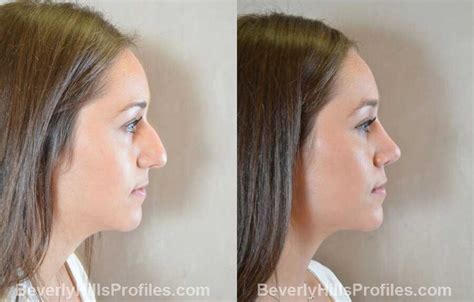 Rhinoplasty Before After Photos Beverly Hills La Rhinoplasty