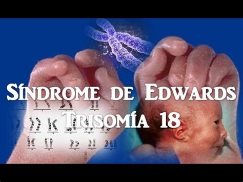 Sindrome Do 18