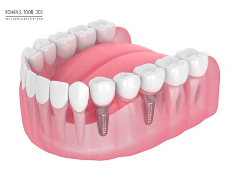 ventura partial dentures cost types     lifespan