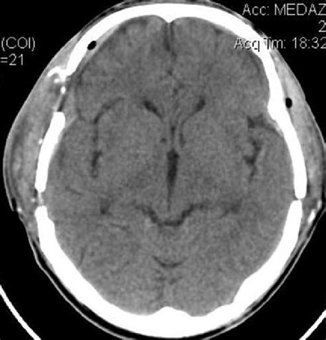 Bilateral Extradural Hematoma Operated With Resolved Hematoma