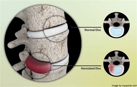 These Common Pain Symptoms May Indicate Herniated Disc (aka “Slipped ...