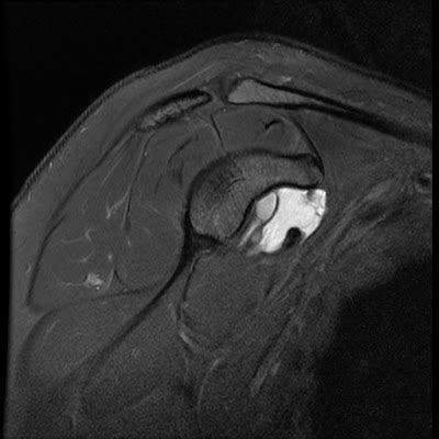 Radiology Cases: Anterosuperior Labral Tear with Paralabral Cyst