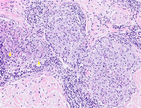 Skin Histology Sarcoidosis