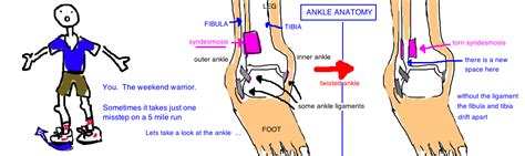 High Ankle Sprain Syndesmotic Ligament Injury — Bone Talks