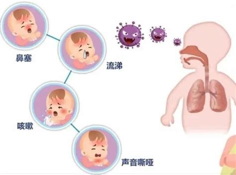 家长们看一看！5岁以下儿童病毒性肺炎最常见病因是 腾讯新闻