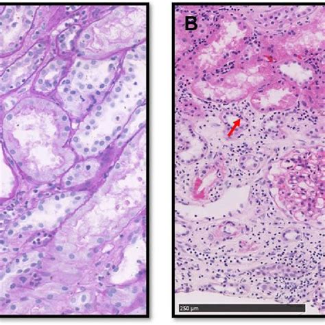 The kidney pathological examination of case 1. (A) PAS stain. (B) H&E... | Download Scientific ...