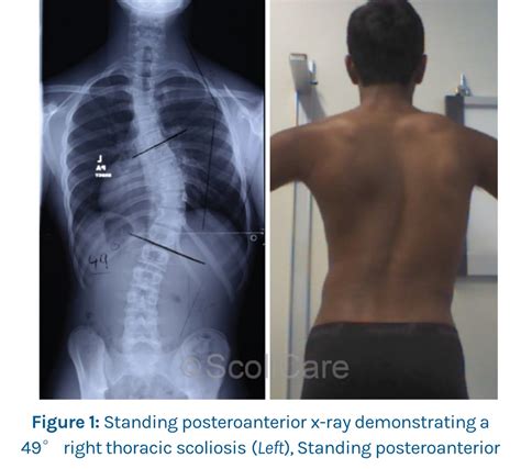 Case Study Reduction Of Severe Scoliosis In 14 Year Old Male ScoliBrace