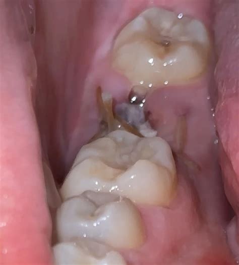 Dry Socket Or Normal Healing R Dentaldudes