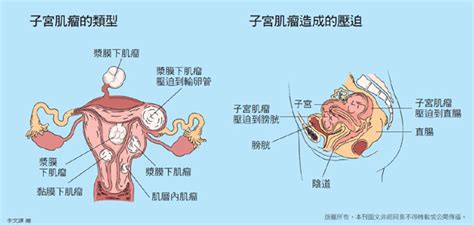 子宮肌瘤 身體百科 康健雜誌