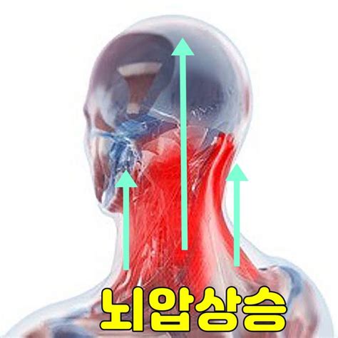 뒷머리찌릿 아플때 왼쪽편두통 귀이명 겁나요 네이버 블로그