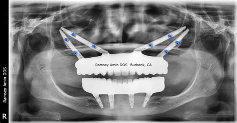 Quad Zygomatic Dental Implants To Replace Dentures Without Bone