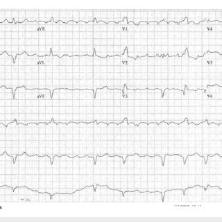 Admission EKG EKG shows low voltage QRS complexes, atrial flutter with ...