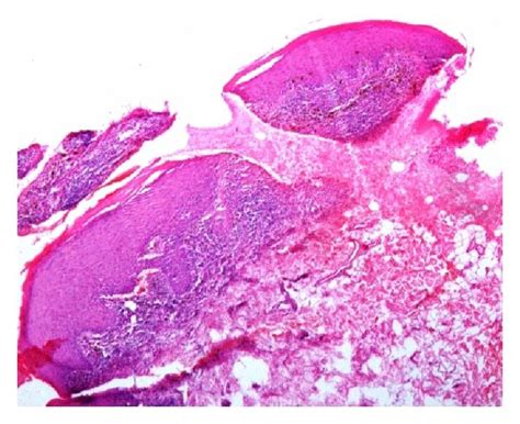 A Shows Localized Band Like Inflammatory Cell Infiltrate In The