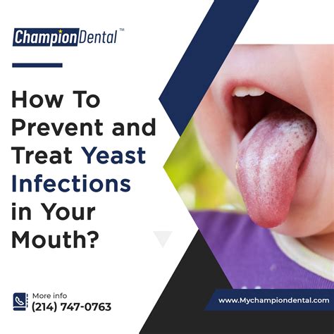 How To Prevent and Treat Yeast Infections in Your Mouth? - Champion Dental