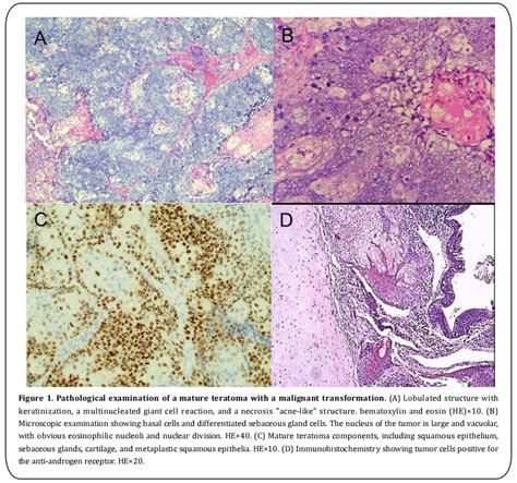 Malignant Transformation Of A Mature Ovarian Teratoma A Case Report