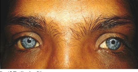 Figure 1 From Waardenburg Syndrome Type 1 In A Sri Lankan Patient Semantic Scholar