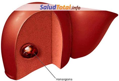 Hemangiomas Hep Ticos S Ntomas Causas Diagn Stico Y Tratamientos