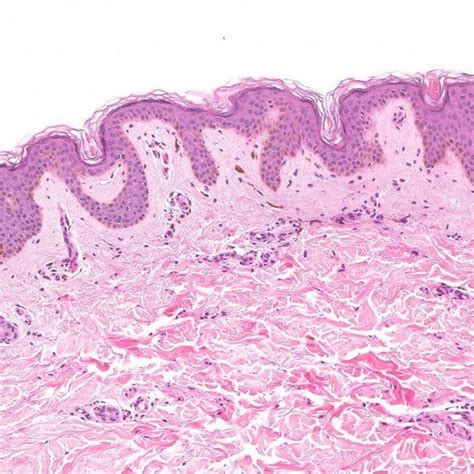 Histological Examination Of Skin Punch Biopsy Shows Focal Hydropic