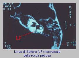 Nervo Facciale Anatomia Decorso Lesione Paralisi ORL