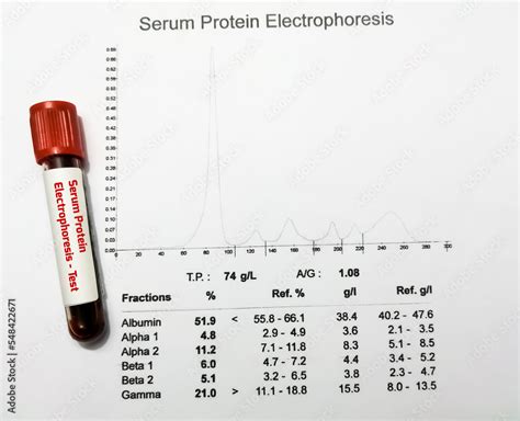 Blood sample and patient's report isolated for Protein Electrophoresis ...