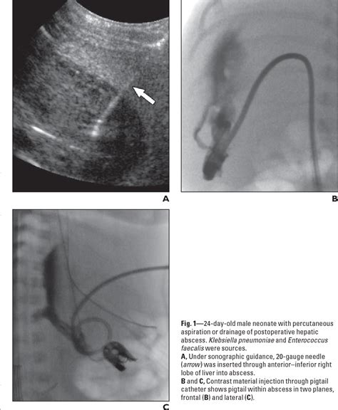 Figure 124 From Imaging Guided Percutaneous Needle Aspiration Or