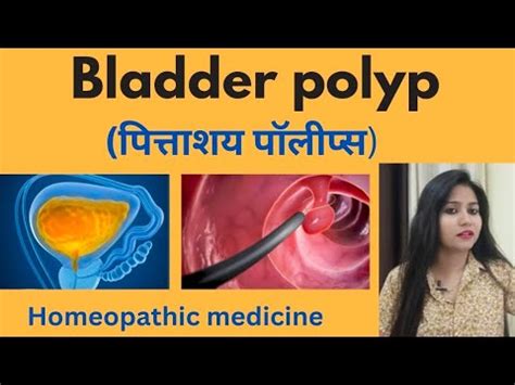 Bladder Polyp Treatment Bladder Polyp Symptoms Causes Homeopathic