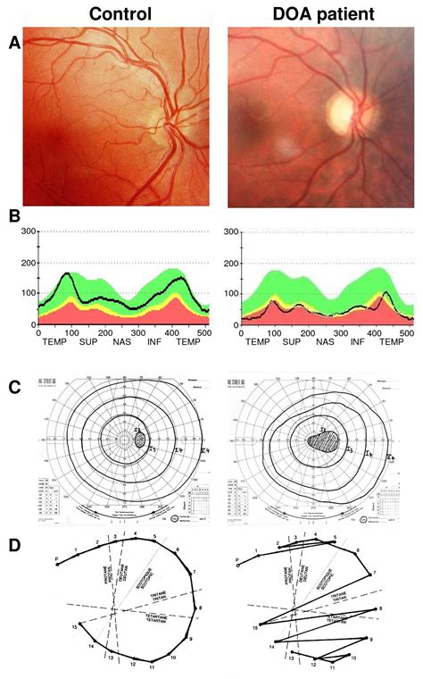 Dominant Optic Atrophy Orphanet Journal Of Rare Diseases Full Text