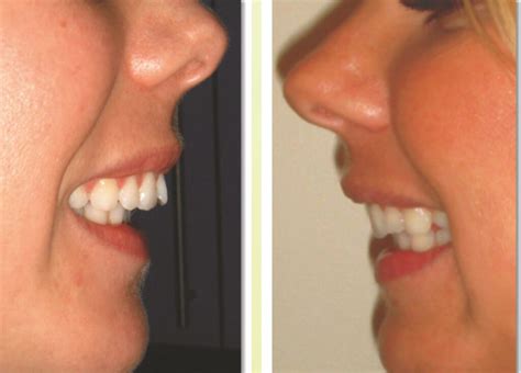 Invisalign Before And After Overjet