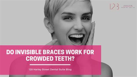 Do Invisible Braces Work for Crowded Teeth? | 128 Harley Street Dental