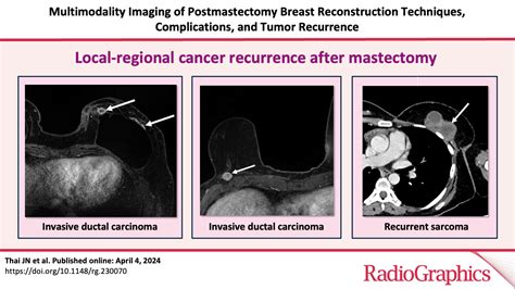 Multimodality Imaging Of Postmastectomy Breast Reconstruction