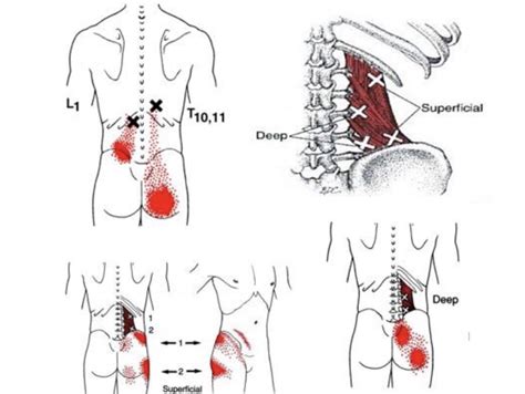 Cc Dry Needling Austin Tx Trigger Point Therapy