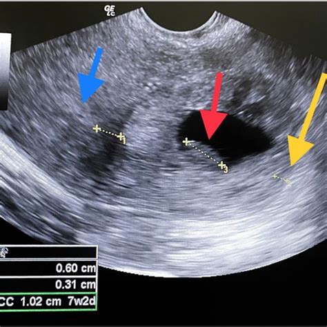 Transvaginal Ultrasound Showing Right Cornual Pregnancy Download Scientific Diagram