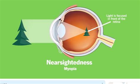 Eye Health: The Causes Of Nearsightedness (Myopia) | Boomers Daily