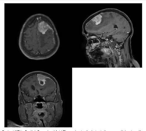 Figure 1 From Dura Based Rhabdoid Glioblastoma Masquerading As