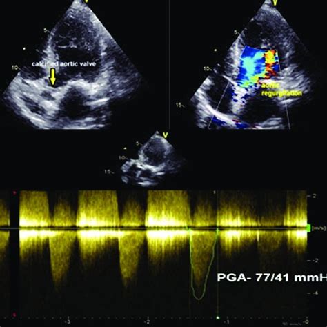 Transthoracic Echocardiography Suprasternal View Coarctation Of