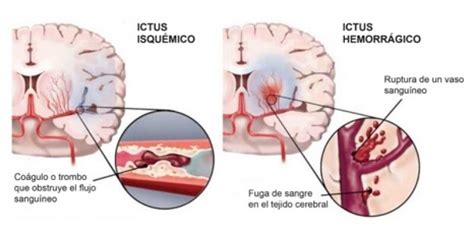 El ictus se convierte en la segunda causa de muerte según la OMS