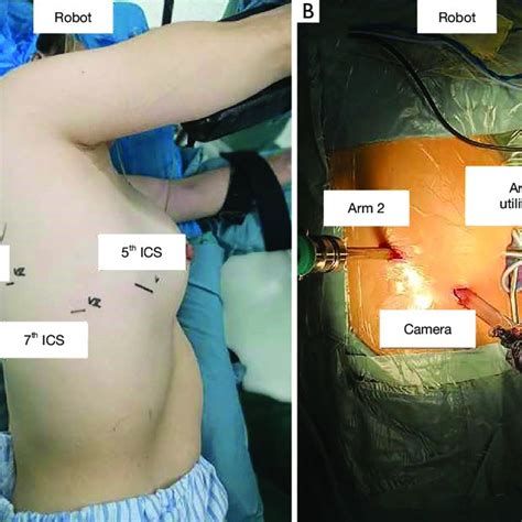 Position Of The Utility Incision And Ports For A Right Sided Lobectomy