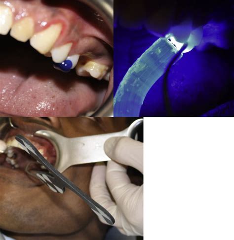 Endodontic Microsurgery Using Dynamic Navigation System A Case Report Journal Of Endodontics