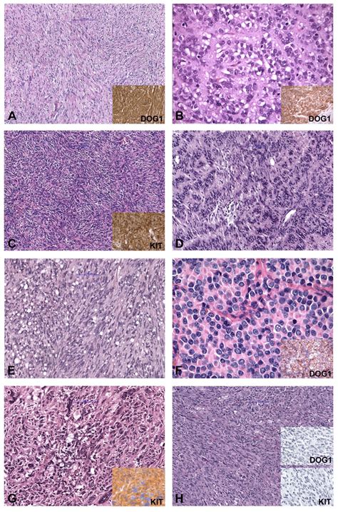 Morphology And Immunohistochemical Findings In Gist Gastrointestinal