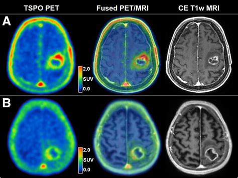 Prognostic Value Of TSPO PET Before Radiotherapy In Newly Diagnosed IDH